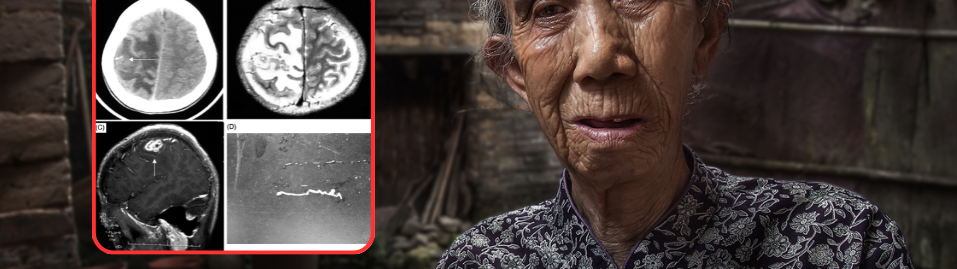 Image for article: ផឹកទឹកកខ្វក់មិនដាំឆ្អិនយូរ! ស្រ្តីវ័យ ៥៦ ឆ្នាំនៅចិនត្រូវវះកាត់បើកលលាដ៍ក្បាលទាំងភ្ញាក់ដឹងខ្លួនដើម្បីយកព្រូនចេញពីខួរក្បាល